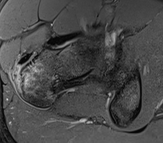 Abductor tendon tears The Bone School